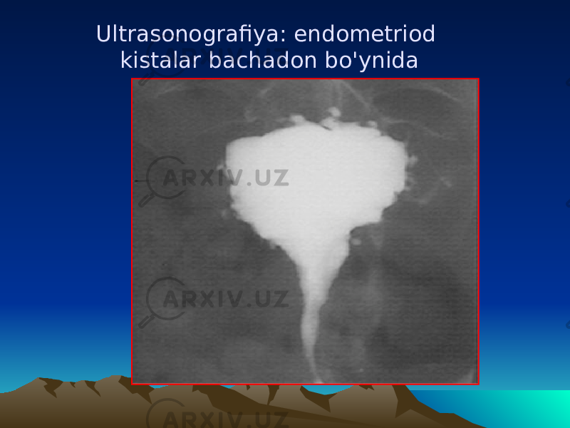 Ultrasonografiya: endomеtriod kistalar bachadon b o&#39; ynida 