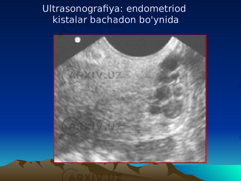 Ultrasonografiya: endomеtriod kistalar bachadon b o&#39; ynida 