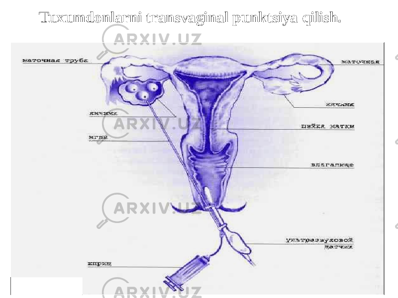  Tuxumdonlarni transvaginal punktsiya qilish. 