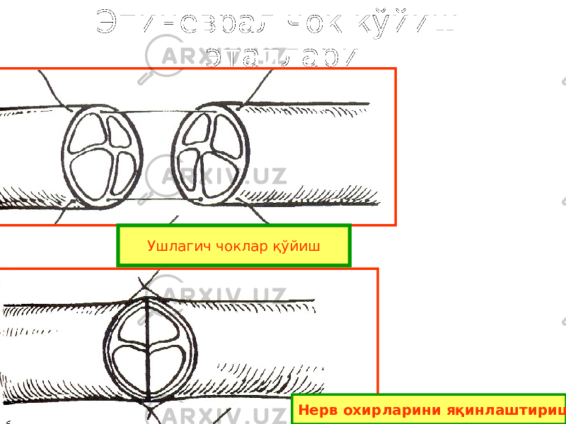 Эпиневрал чок қўйиш этаплари Ушлагич чоклар қўйиш Нерв охирларини яқинлаштириш 