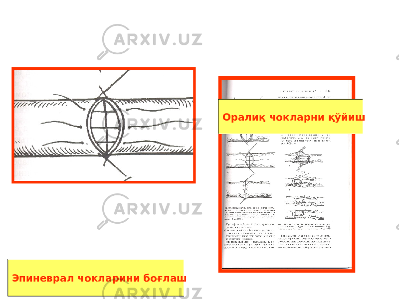 Оралиқ чокларни қўйиш Эпиневрал чокларини боғлаш 