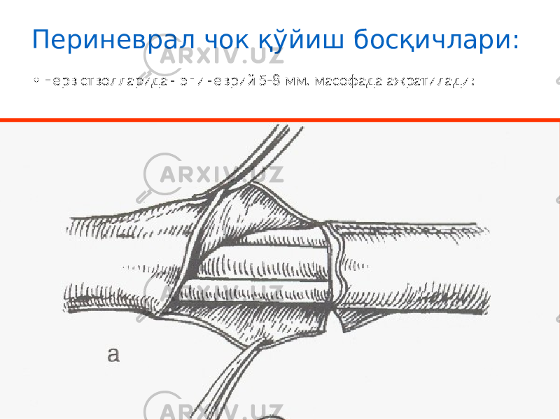 Периневрал чок қўйиш босқичлари: • Нерв стволларидан эпиневрий 5-8 мм. масофада ажратилади: 