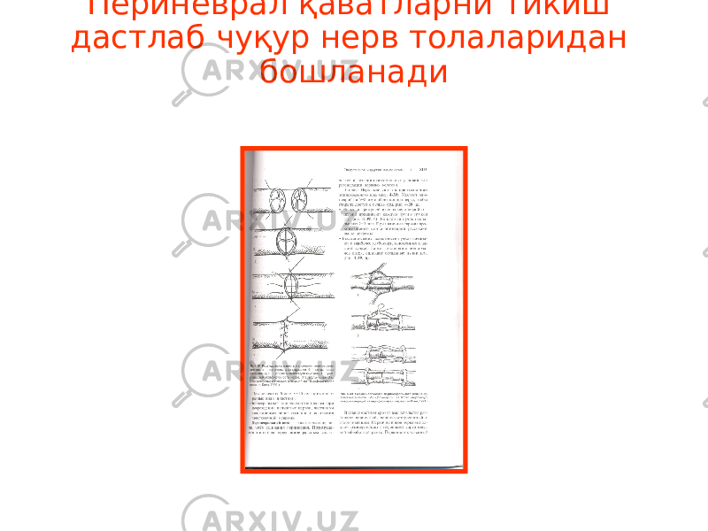 Периневрал қаватларни тикиш дастлаб чуқур нерв толаларидан бошланади 