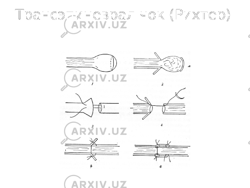 Трансэпиневрал чок (Рихтер) 