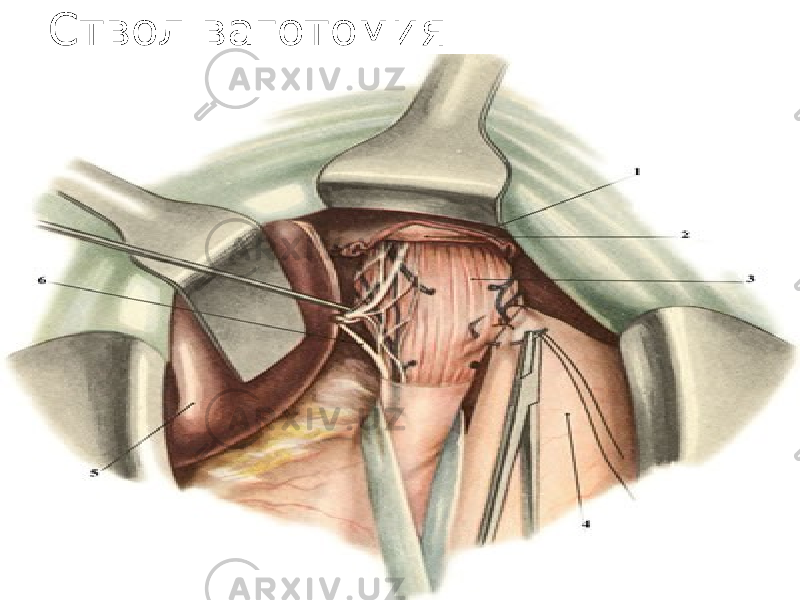 Ствол ваготомия 