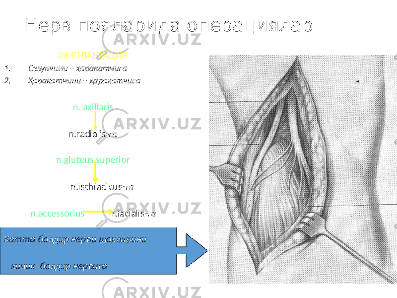 Нерв пояларида операциялар ИМПЛАНТАЦИЯ 1. Сезувчини – ҳаракатчига 2. Ҳаракатчини – ҳаракатчига n. axillaris n.radialis- га n.gluteus superior n.ischiadicus- га n.accessorius n.facialis- га Катта болдир нерви шохларини кичик болдир нервига 