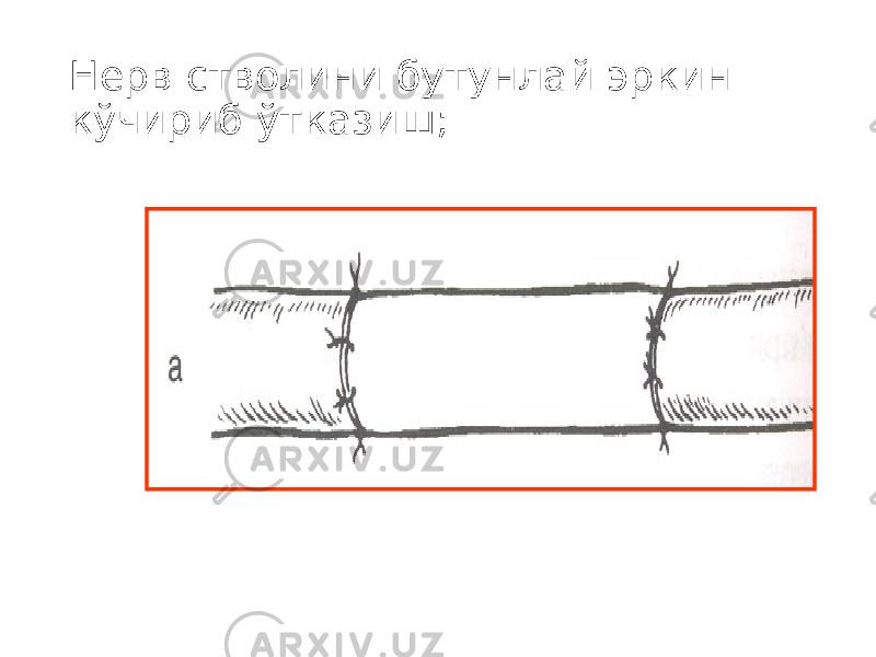 Нерв стволини бутунлай эркин кўчириб ўтказиш; 