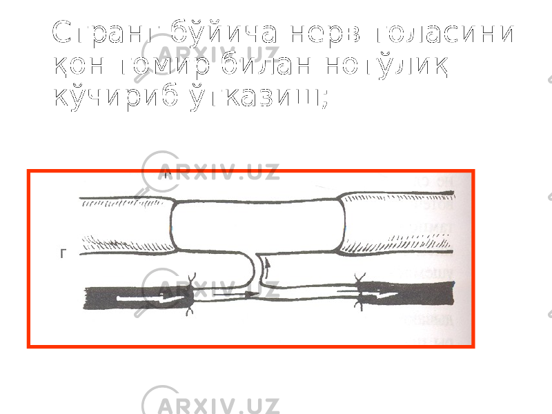 Странг бўйича нерв толасини қон томир билан нотўлиқ кўчириб ўтказиш; 