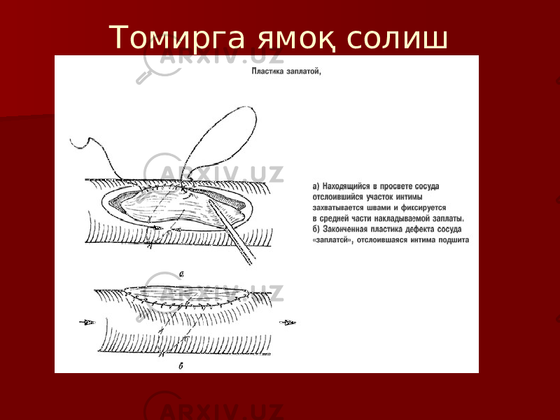 Томирга ямоқ солиш 