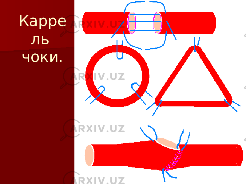 Карре ль чоки. 