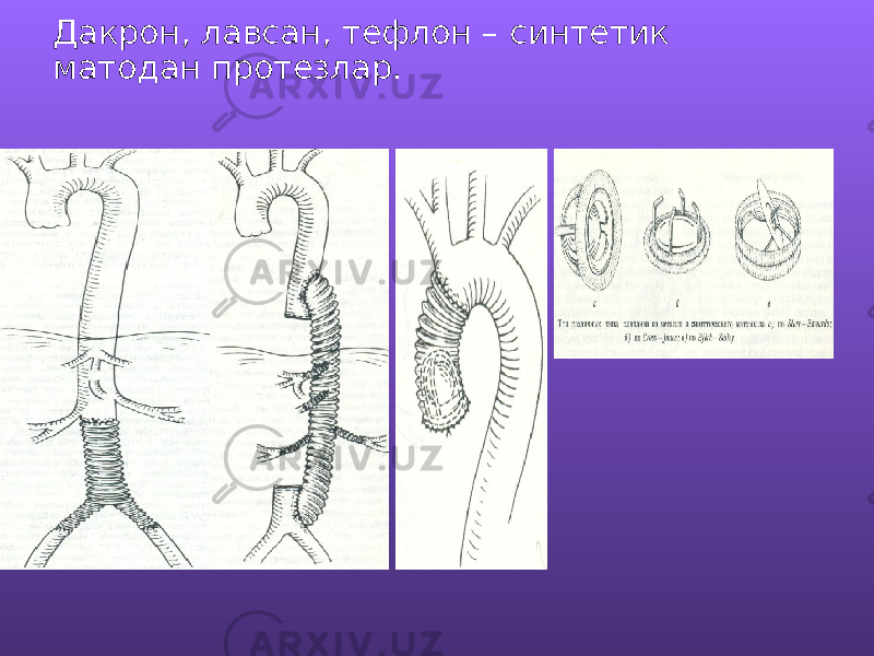 Дакрон, лавсан, тефлон – синтетик матодан протезлар. 