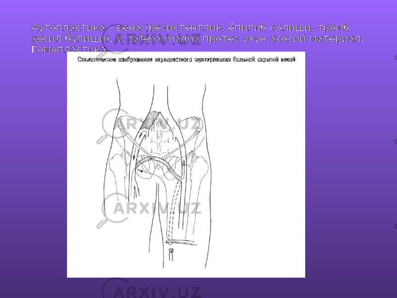 Аутопластика – вена (резистентлик, ёпилиб қолиши, тромб ҳосил бўлиши). V. safena magna протез учун асосий материал. Гомопластика. 