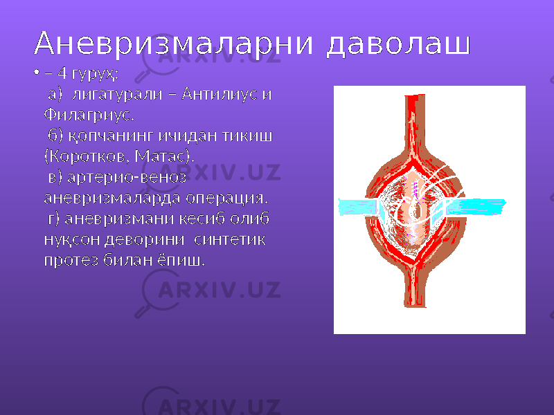 Аневризмаларни даволаш • – 4 гуруҳ: а) лигатурали – Антилиус и Филагриус. б) қопчанинг ичидан тикиш (Коротков, Матас). в) артерио-веноз аневризмаларда операция. г) аневризмани кесиб олиб нуқсон деворини синтетик протез билан ёпиш. 