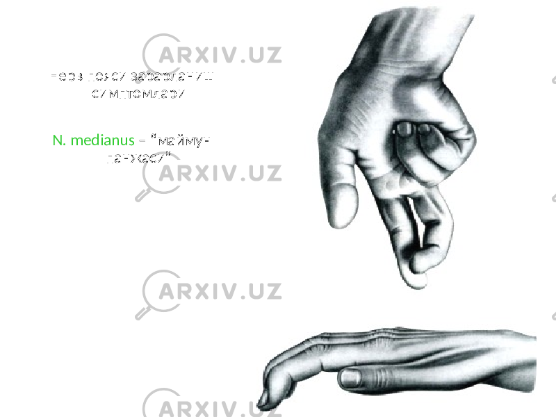 Нерв пояси зарарланиш симптомлари N. medianus – “маймун панжаси” 