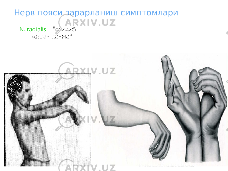 Нерв пояси зарарланиш симптомлари N. radialis – “осилиб қолган панжа” 