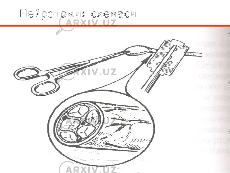 Нейротомия схемаси 