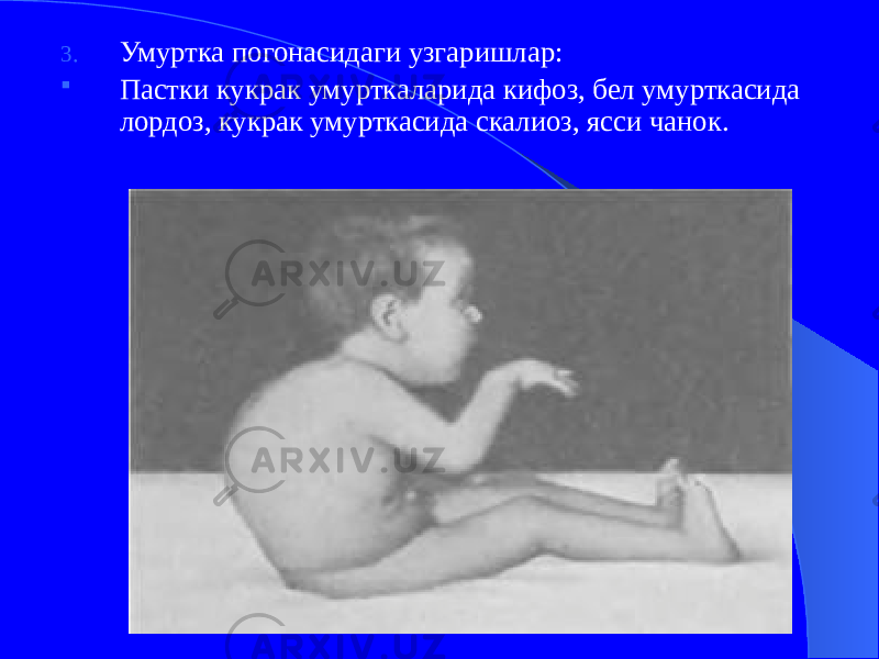 3. Умуртка погонасидаги узгаришлар:  Пастки кукрак умурткаларида кифоз, бел умурткасида лордоз, кукрак умурткасида скалиоз, ясси чанок. 