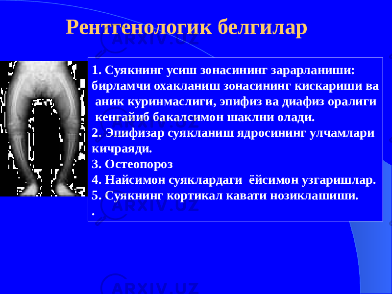 Рентгенологик белгилар 1. Суякнинг усиш зонасининг зарарланиши: бирламчи охакланиш зонасининг кискариши ва аник куринмаслиги, эпифиз ва диафиз оралиги кенгайиб бакалсимон шаклни олади. 2. Эпифизар суякланиш ядросининг улчамлари кичраяди. 3. Остеопороз 4. Найсимон суяклардаги ёйсимон узгаришлар. 5. Суякнинг кортикал кавати нозиклашиши. . 