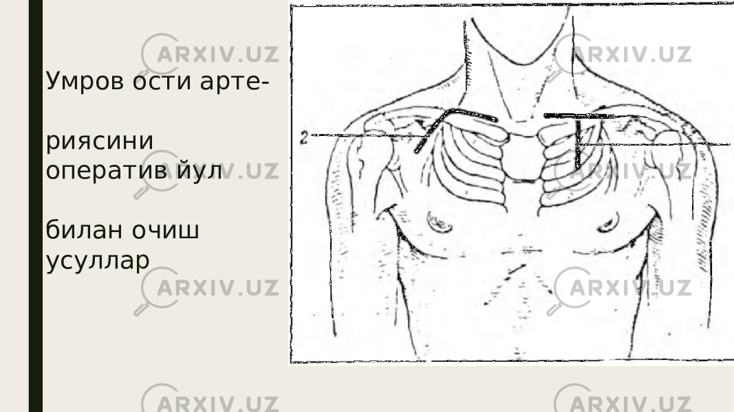 Умров ости арте- риясини оператив йул билан очиш усуллар 