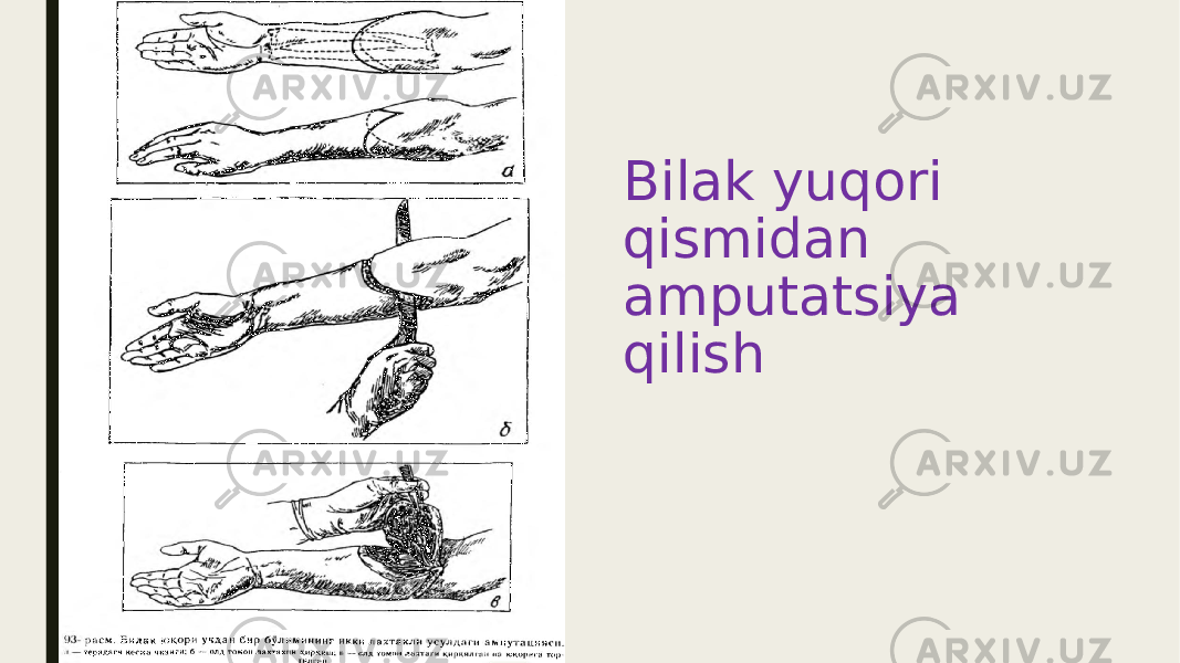 Bilak yuqori qismidan amputatsiya qilish 