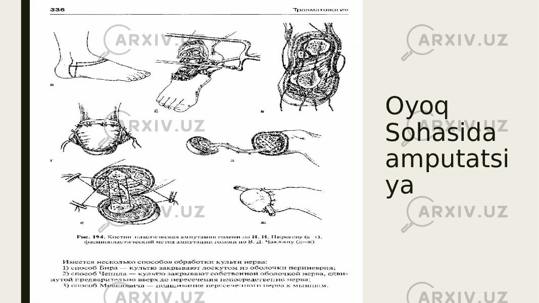 Oyoq Sohasida amputatsi ya 