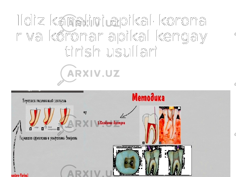 Ildiz kanalini apikal-korona r va koronar apikal kengay tirish usullari 