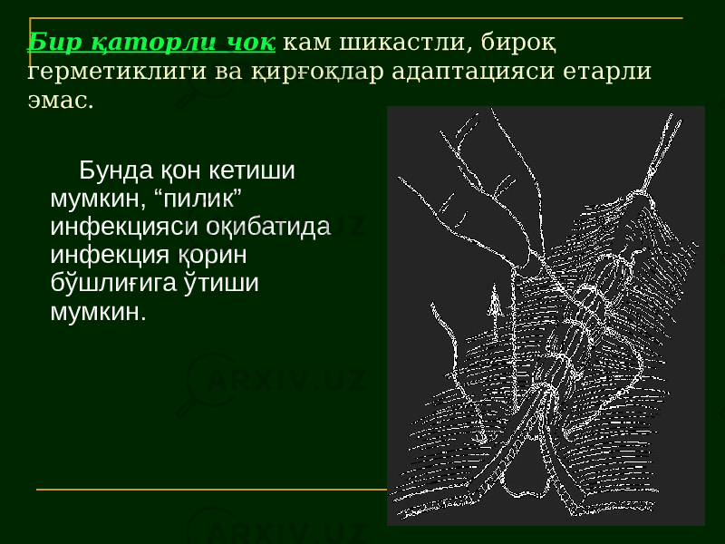 Бир қаторли чок кам шикастли, бироқ герметиклиги ва қирғоқлар адаптацияси етарли эмас. Бунда қон кетиши мумкин, “пилик” инфекцияси оқибатида инфекция қорин бўшлиғига ўтиши мумкин. 