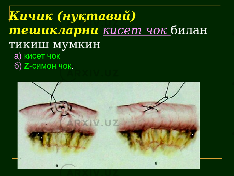 Кичик (нуқтавий) тешикларни кисет чок билан тикиш мумкин а) кисет чок б) Z -симон чок . 