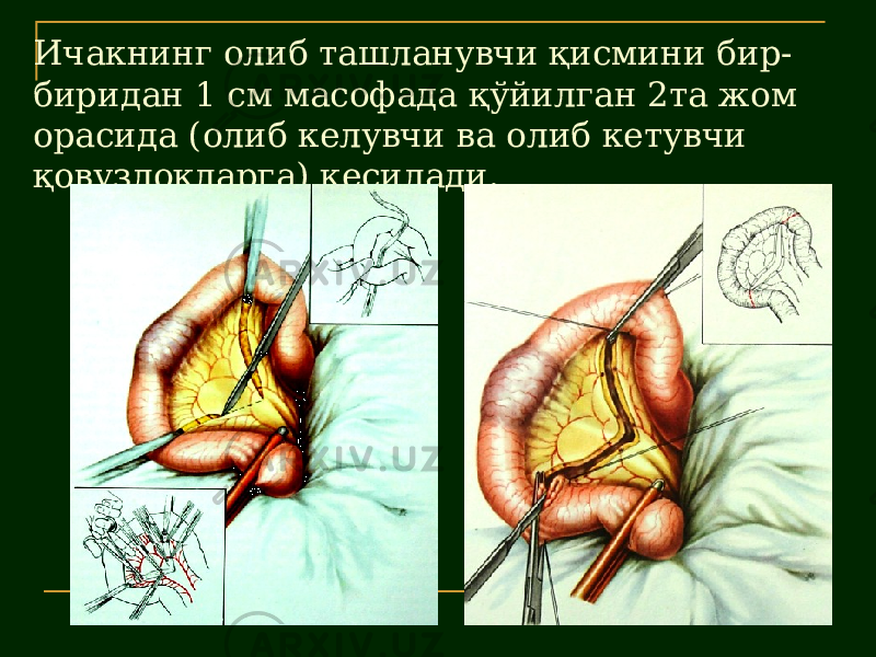 Ичакнинг олиб ташланувчи қисмини бир- биридан 1 см масофада қўйилган 2та жом орасида (олиб келувчи ва олиб кетувчи қовузлоқларга) кесилади. 