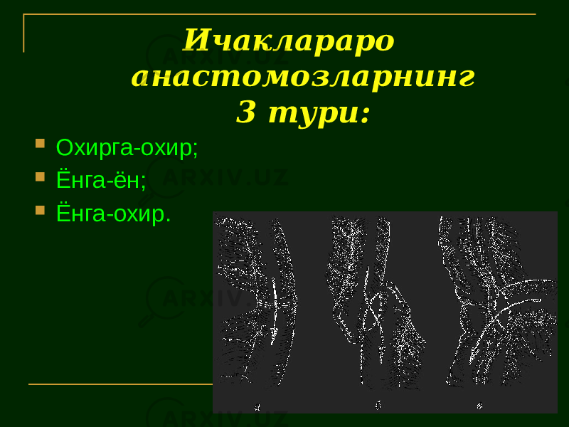  Ичаклараро анастомозларнинг 3 тури:  Охирга-охир;  Ёнга-ён;  Ёнга-охир. 