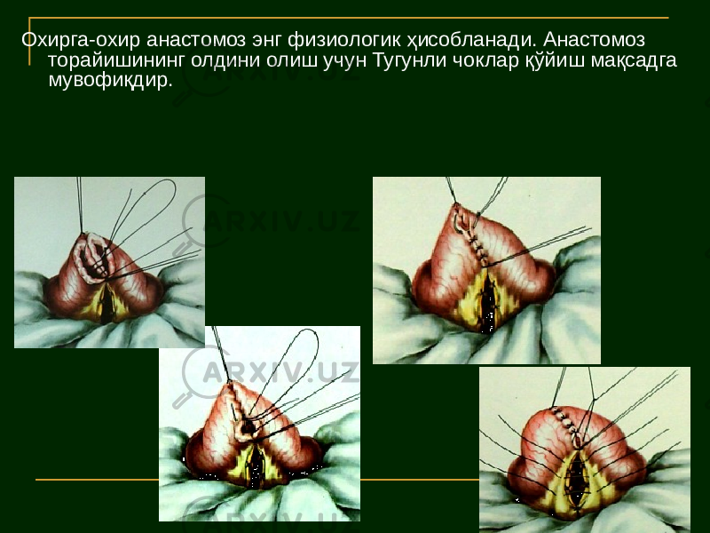 Охирга-охир анастомоз энг физиологик ҳисобланади. Анастомоз торайишининг олдини олиш учун Тугунли чоклар қўйиш мақсадга мувофиқдир. 