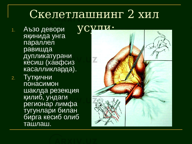 Скелетлашнинг 2 хил усули:1. Аъзо девори яқинида унга параллел равишда дупликатурани кесиш (хавфсиз касалликларда). 2. Тутқични понасимон шаклда резекция қилиб, ундаги регионар лимфа тугунлари билан бирга кесиб олиб ташлаш. 