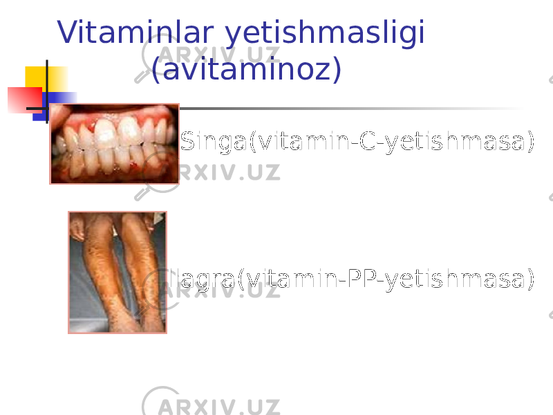 Vitaminlar yetishmasligi (avitaminoz)  Singa(vitamin-C-yetishmasa)  Pellagra(vitamin-PP-yetishmasa) 