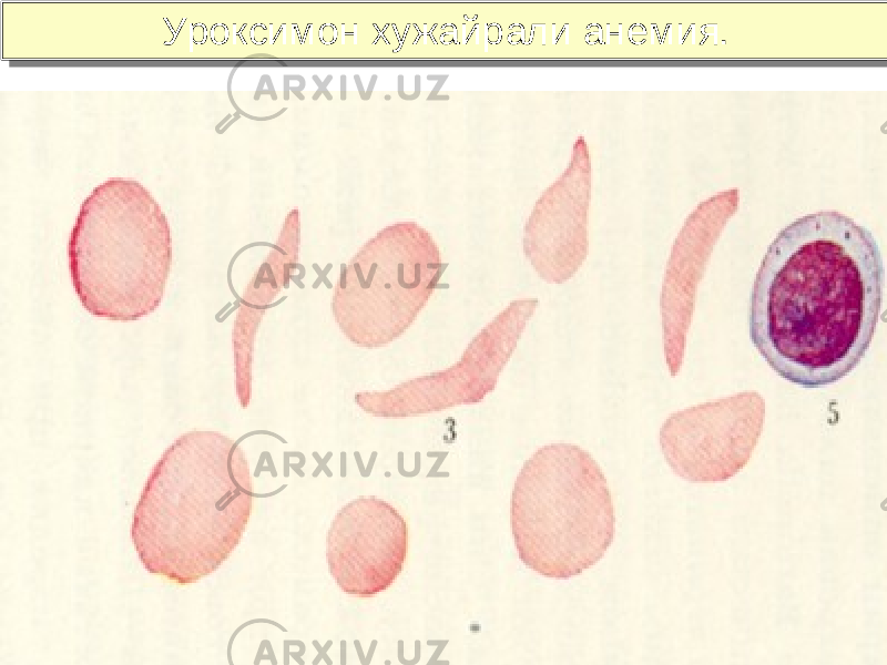 11Уроксимон хужайрали анемия. Уроксимон хужайрали анемия. 