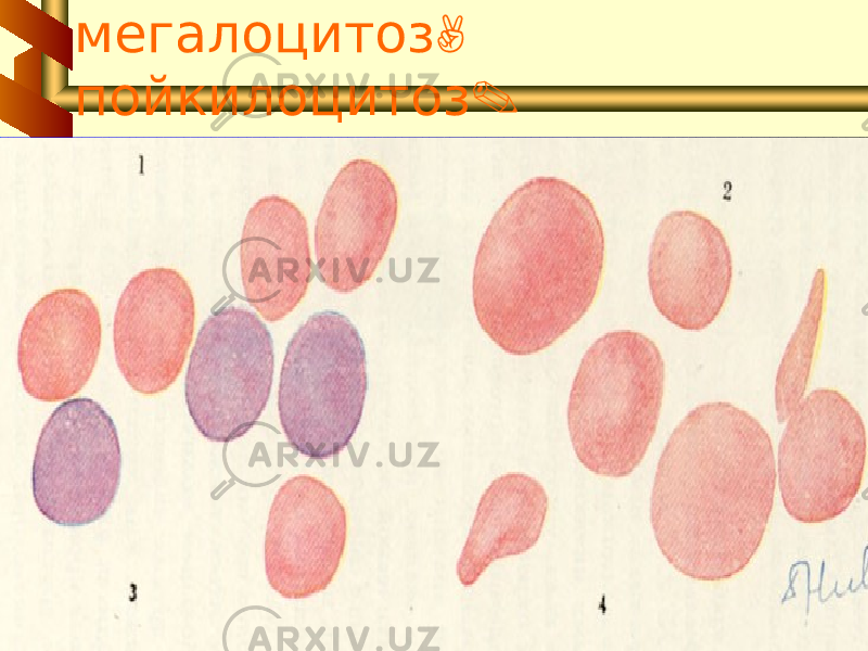 5, Полихромафилия , макроцитоз , мегалоцитоз . пойкилоцитоз 71 