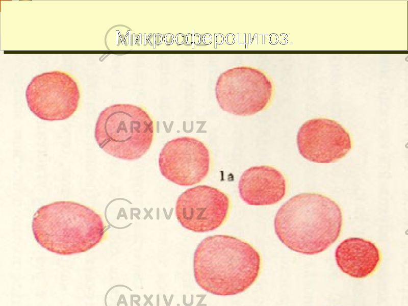 9Микросфероцитоз.Микросфероцитоз. 