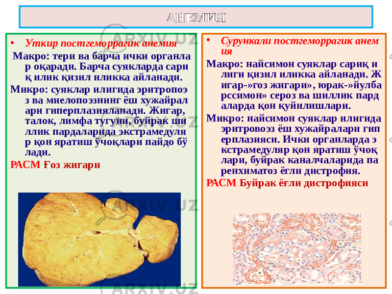 • Уткир постгеморрагик анемия Макро: тери ва барча ички органла р оқаради. Барча суякларда сари қ илик қизил иликка айланади. Микро: суяклар илигида эритропоэ з ва миелопоэзнинг ёш хужайрал ари гиперплазияланади. Жигар, талок, лимфа тугуни, буйрак ши ллик пардаларида экстрамедуля р қон яратиш ўчоқлари пайдо бў лади. РАСМ Ғоз жигари • Сурункали постгеморрагик анем ия Макро: найсимон суяклар сариқ и лиги қизил иликка айланади. Ж игар-»гоз жигари», юрак-»йулба рссимон» сероз ва шиллик пард аларда қон қуйилишлари. Микро: найсимон суяклар илигида эритровоэз ёш хужайралари гип ерплазияси. Ички органларда э кстрамедуляр қон яратиш ўчоқ лари, буйрак каналчаларида па ренхиматоз ёгли дистрофия. РАСМ Буйрак ёғли дистрофиясиАНЕМИЯ 