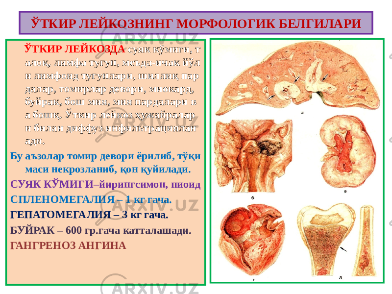  ЎТКИР ЛЕЙКОЗДА суяк кўмиги, т алоқ, лимфа тугун, меъда-ичак йўл и лимфоид тугунлари, шиллиқ пар далар, томирлар девори, миокард, буйрак, бош мия, мия пардалари в а бошқ. Ўткир лейкоз ҳужайралар и билан диффуз инфильтрациялан ади. Бу аъзолар томир девори ёрилиб, тўқи маси некрозланиб, қон қуйилади. СУЯК КЎМИГИ–йирингсимон, пиоид СПЛЕНОМЕГАЛИЯ – 1 кг гача. ГЕПАТОМЕГАЛИЯ – 3 кг гача. БУЙРАК – 600 гр.гача катталашади. ГАНГРЕНОЗ АНГИНА ЎТКИР ЛЕЙКОЗНИНГ МОРФОЛОГИК БЕЛГИЛАРИ 