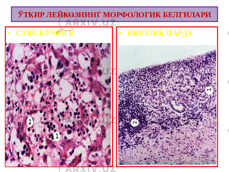 • СУЯК КЎМИГИ • ШИЛЛИҚ ПАРДАЎТКИР ЛЕЙКОЗНИНГ МОРФОЛОГИК БЕЛГИЛАРИ 