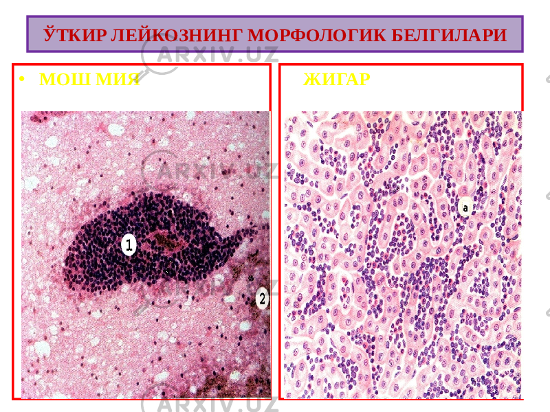 • МОШ МИЯ ЖИГАРЎТКИР ЛЕЙКОЗНИНГ МОРФОЛОГИК БЕЛГИЛАРИ 