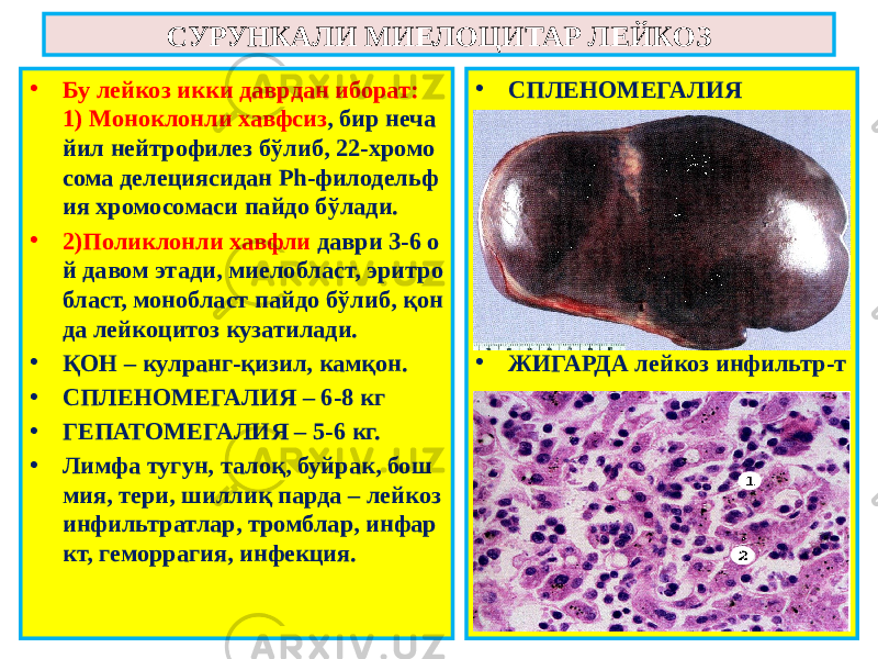 • Бу лейкоз икки даврдан иборат: 1) Моноклонли хавфсиз , бир неча йил нейтрофилез бўлиб, 22-хромо сома делециясидан Ph-филодельф ия хромосомаси пайдо бўлади. • 2)Поликлонли хавфли даври 3-6 о й давом этади, миелобласт, эритро бласт, монобласт пайдо бўлиб, қон да лейкоцитоз кузатилади. • ҚОН – кулранг-қизил, камқон. • СПЛЕНОМЕГАЛИЯ – 6-8 кг • ГЕПАТОМЕГАЛИЯ – 5-6 кг. • Лимфа тугун, талоқ, буйрак, бош мия, тери, шиллиқ парда – лейкоз инфильтратлар, тромблар, инфар кт, геморрагия, инфекция. • СПЛЕНОМЕГАЛИЯ • ЖИГАРДА лейкоз инфильтр-тСУРУНКАЛИ МИЕЛОЦИТАР ЛЕЙКОЗ 
