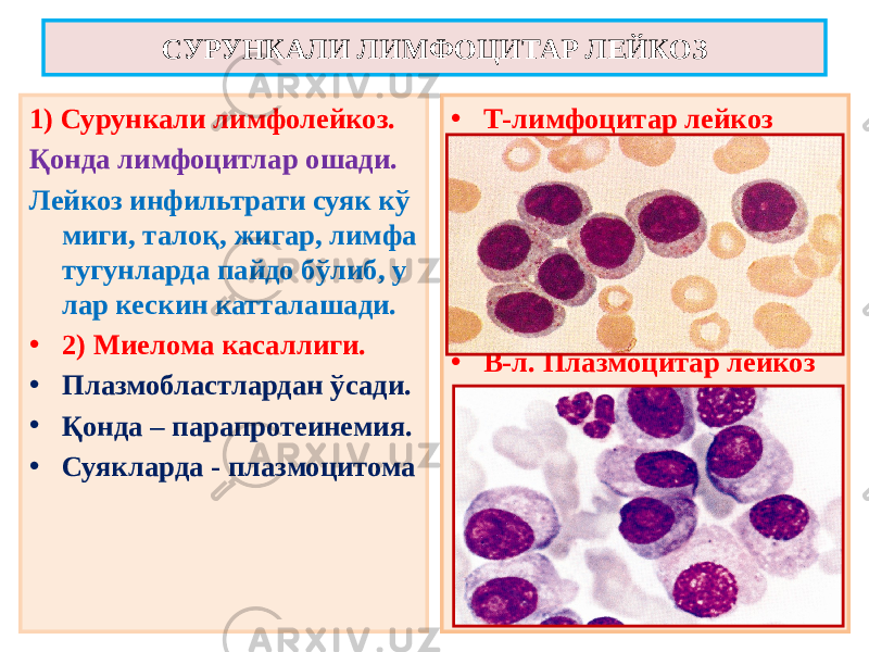 1) Сурункали лимфолейкоз. Қонда лимфоцитлар ошади. Лейкоз инфильтрати суяк кў миги, талоқ, жигар, лимфа тугунларда пайдо бўлиб, у лар кескин катталашади. • 2) Миелома касаллиги. • Плазмобластлардан ўсади. • Қонда – парапротеинемия. • Суякларда - плазмоцитома • Т-лимфоцитар лейкоз • В-л. Плазмоцитар лейкозСУРУНКАЛИ ЛИМФОЦИТАР ЛЕЙКОЗ 