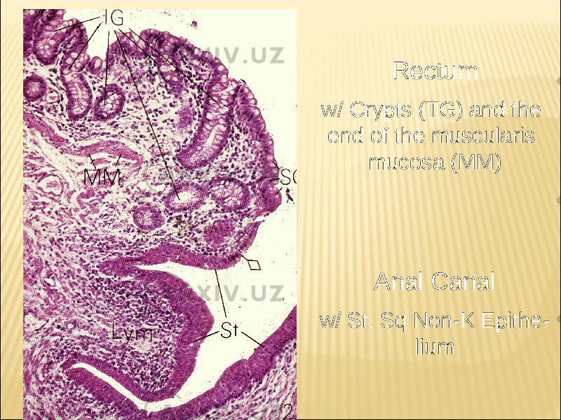 Rectum w/ Crypts (TG) and the end of the muscularis mucosa (MM) Anal Canal w/ St. Sq Non-K Epithe - lium 