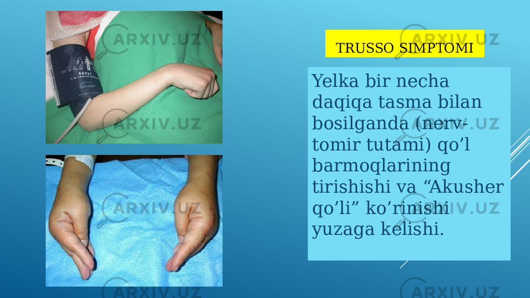 TRUSSO SIMPTOMI Yelka bir necha daqiqa tasma bilan bosilganda (nerv- tomir tutami) qo’l barmoqlarining tirishishi va “Akusher qo’li” ko’rinishi yuzaga kelishi. 