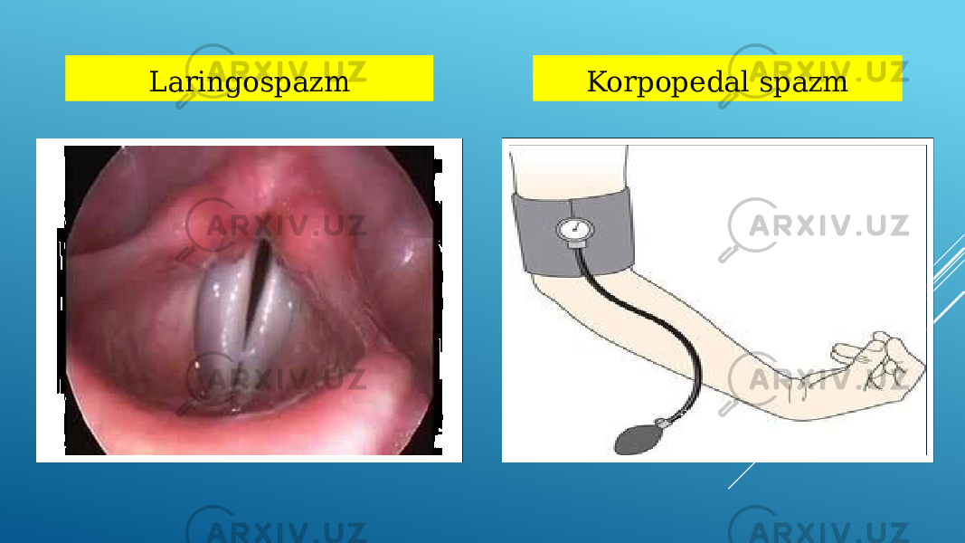 Laringospazm Korpopedal spazm 