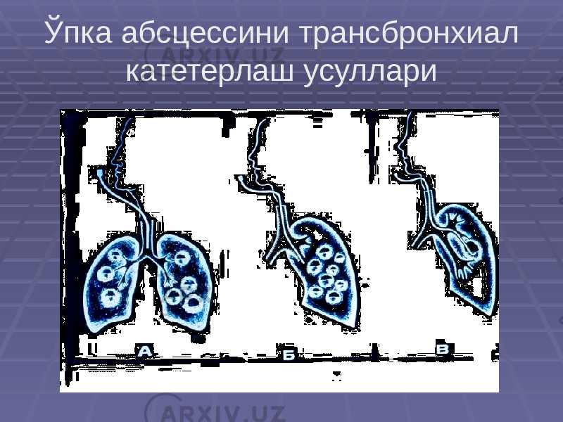 Ўпка абсцессини трансбронхиал катетерлаш усуллари 