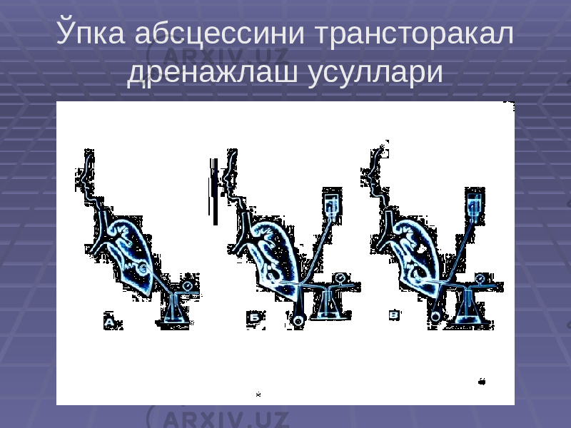 Ўпка абсцессини трансторакал дренажлаш усуллари 