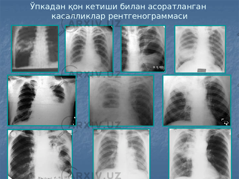 Ўпкадан қон кетиши билан асоратланган касалликлар рентгенограммаси 