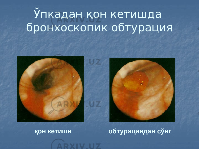 Ўпкадан қон кетишда бронхоскопик обтурация қон кетиши обтурациядан сўнг 