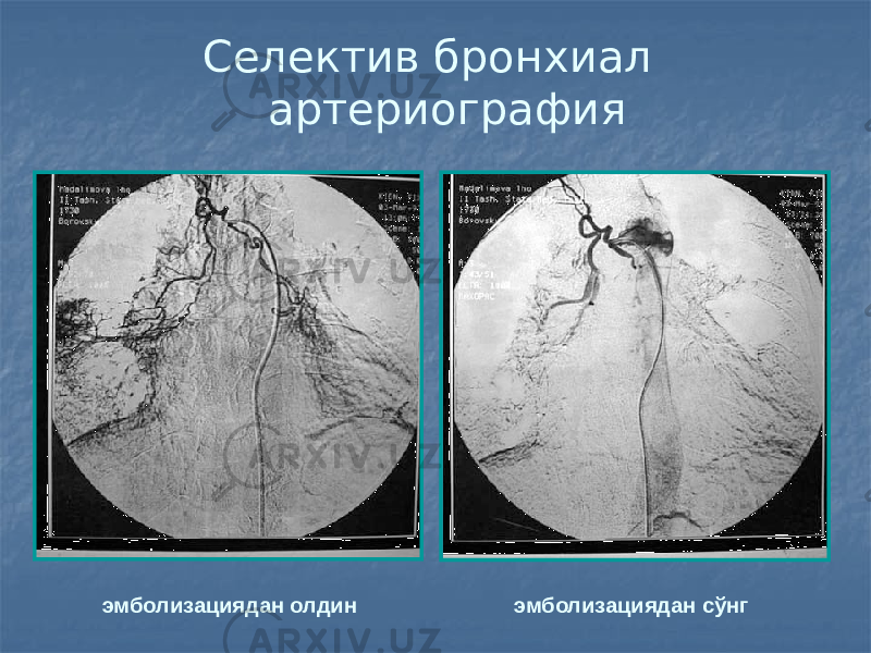  Селектив бронхиал артериография эмболизациядан олдин эмболизациядан сўнг 